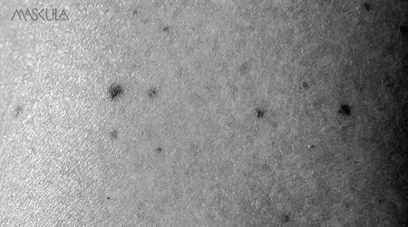 Melasma vs. Flek Hitam: Beda di Mana & Bagaimana Cara Ngatasinnya