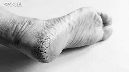 Solusi Kaki Batu: Cara Ampuh Atasi Kulit Kaki Pecah-Pecah