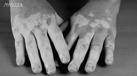 Vitiligo dan Kepercayaan Diri: Cara Tetap Pede dengan Kulit Unik Lo