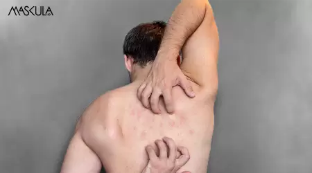 Jarang Disadari! Kebiasaan Sepele yang Bisa Menyebabkan Jerawat di Punggung