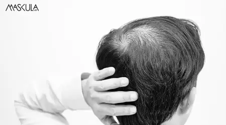 Waspada! Kebotakan 'Incar' Milenial Usia 20an